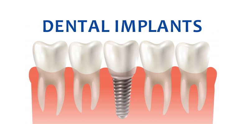 Dental Implants & Jawbone Health: The Connection - Life Style Inspiring