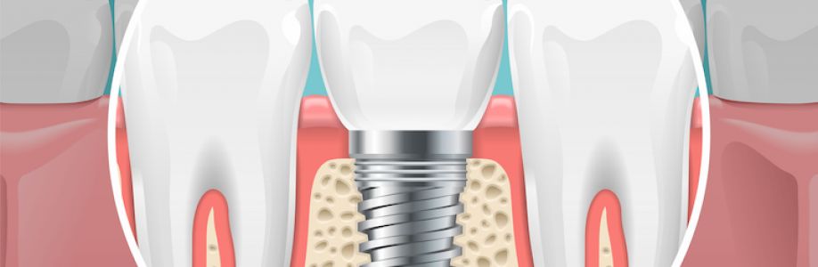 Nuteeth Dental Implant Center Cover Image