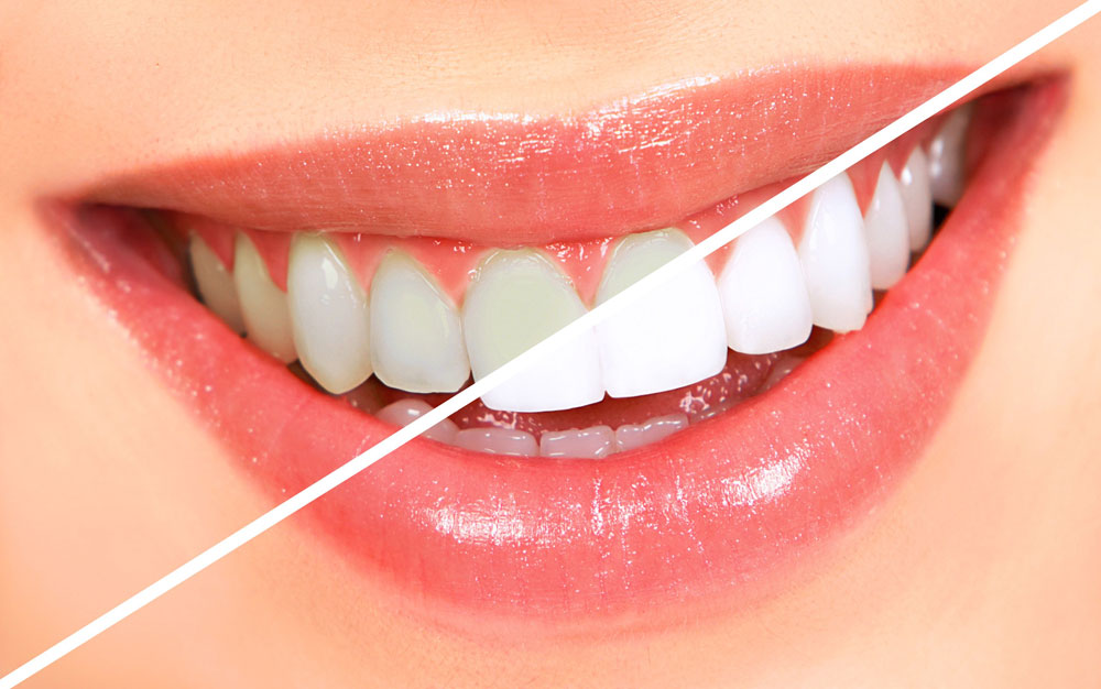 The Colony Teeth Whitening - Teeth Whitening Lewisville TX - D. Dental