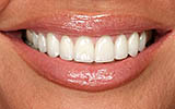 Smile Makeover - Dental Smile Makeover - D. Dental The Colony Dentist