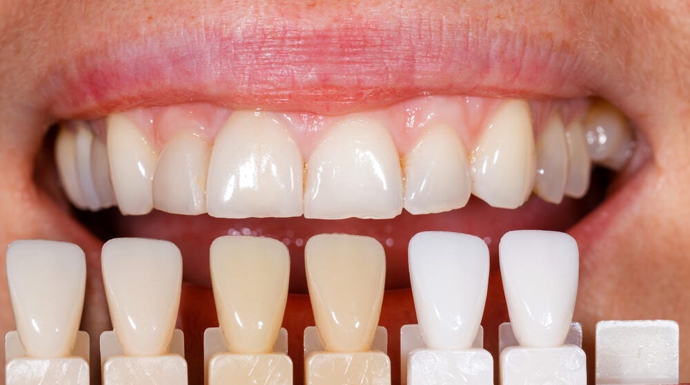 Composite vs. Porcelain Veneers: Choosing the Right Option for You | by Newport Dental Group | May, 2024 | Medium