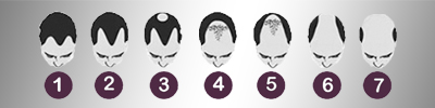 Cost of Hairline Transplant Explained by a Hair Surgeon