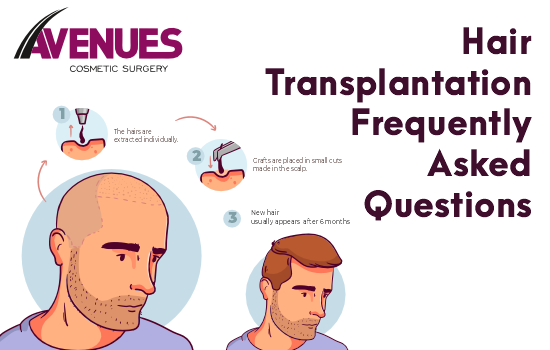 Hair Transplant Frequently Asked Questions - Avenuescosmetic