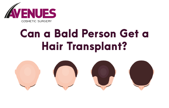 Can a Bald Person Get a Hair Transplant?