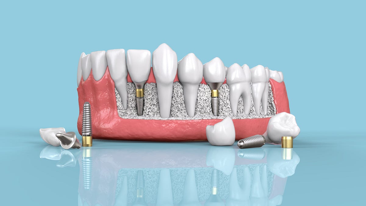 Your Guide to Dental Implants: From Consultation to Final Restoration | by SmileLand Dental Family Dentistry & Orthodontics | May, 2024 | Medium