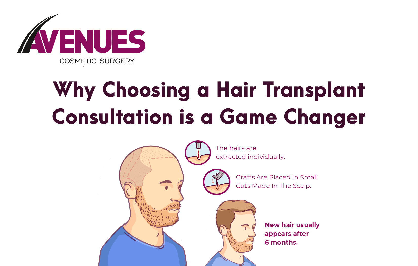 Why Choosing a Hair Transplant Consultation is a Game Changer