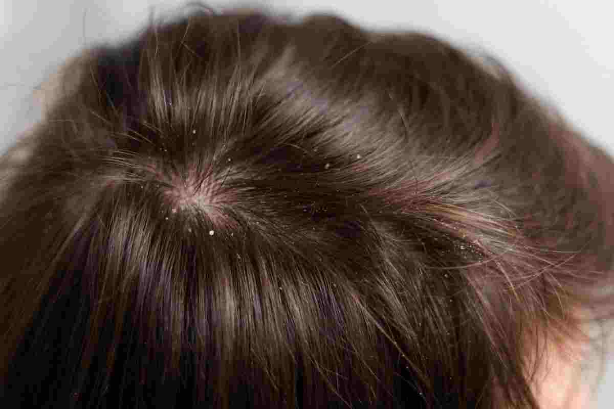 Understanding Dry Scalp