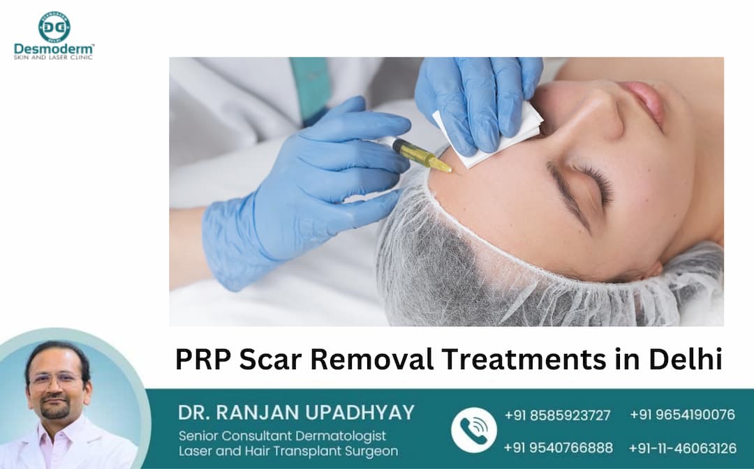 Revitalize Your Skin: PRP Scar Removal Treatments in Delhi | Zupyak