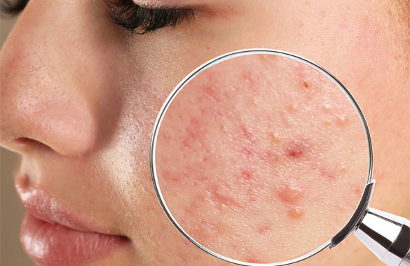 Best Acne Treatment Center in Delhi | Dermasure Clinic